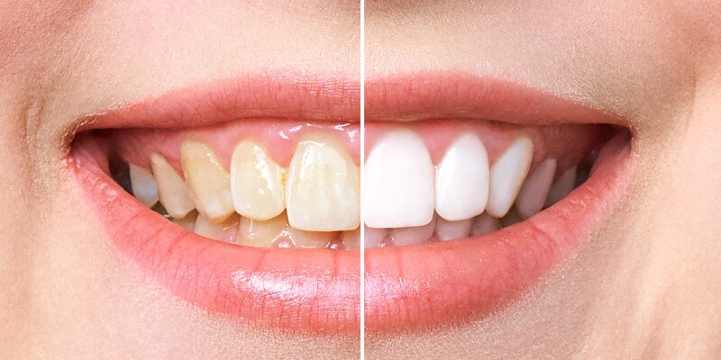 witte tanden before after